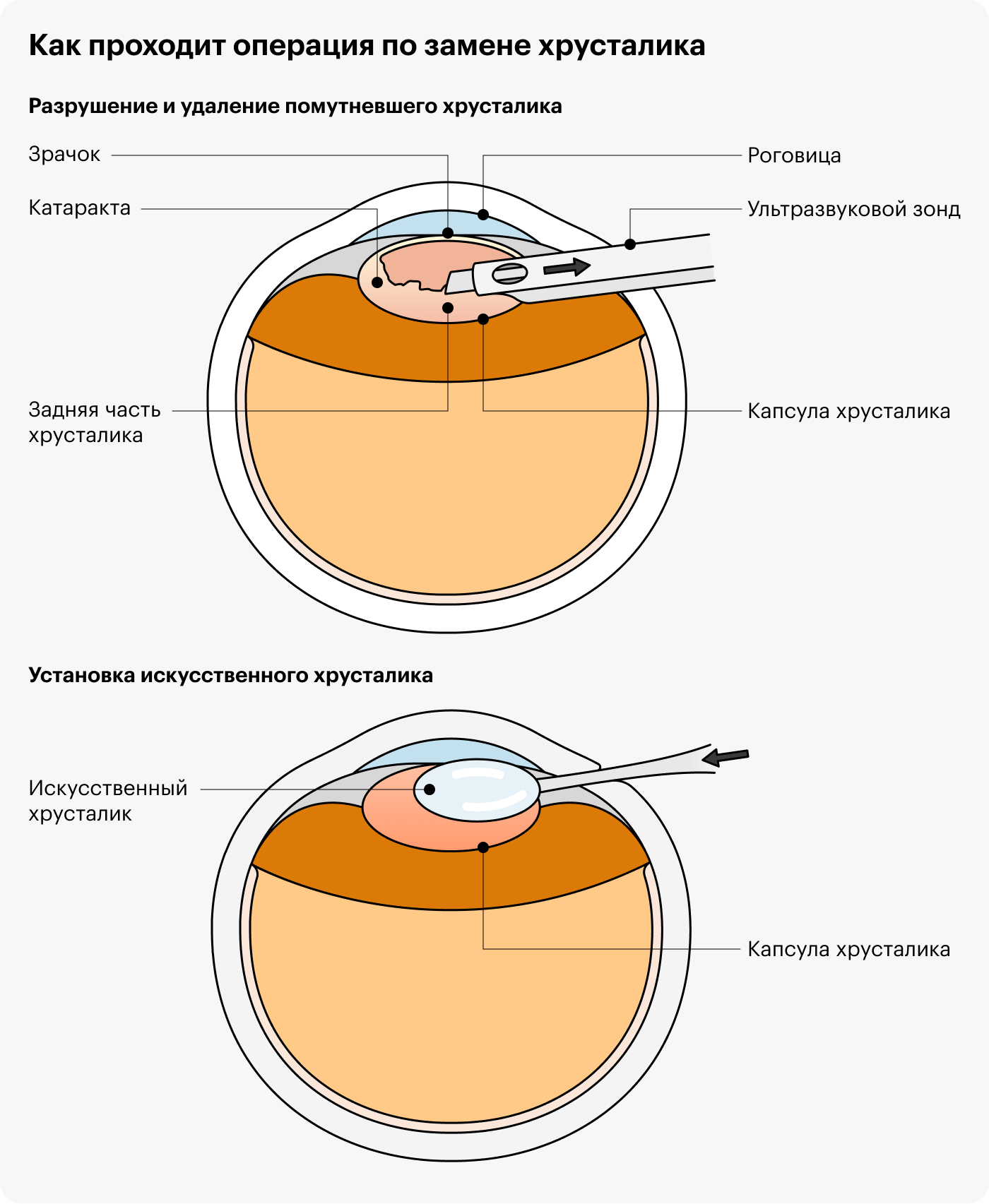 Так проходит операция по замене хрусталика: ультразвуковой зонд помогает разрушить помутневший хрусталик, затем его отсасывают, а в капсулу хрусталика помещают искусственный. Источник: mayoclinic.org