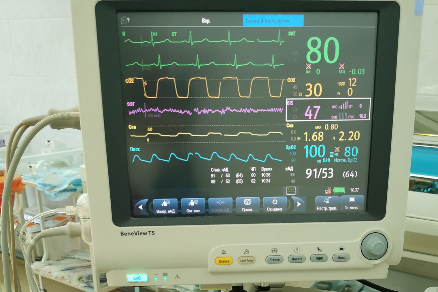 Интраоперационный мониторинг пациента. Сиреневые цифры в прямоугольнике — BIS-мониторинг. Значение 47 соответствует умеренной седации