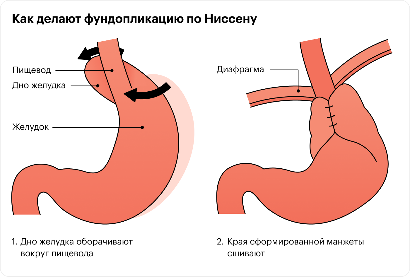 Фундопликацию проводят пациентам с ГЭРБ, которым не помогает лекарственная терапия. Источник: mayoclinic.org