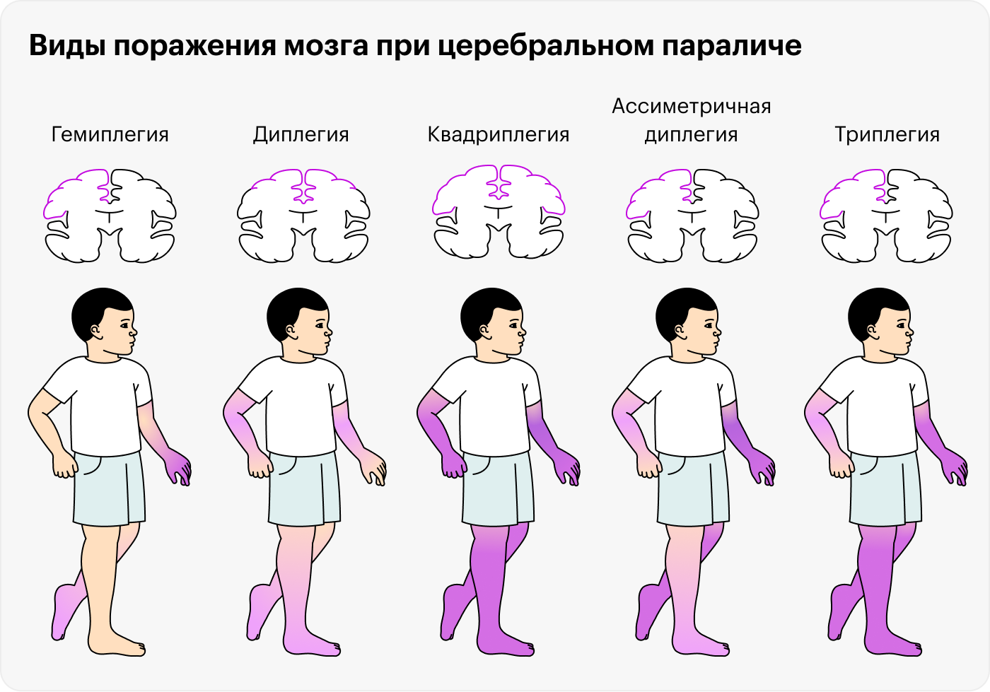 Церебральный паралич проявляется по⁠-⁠разному, в зависимости от того, какой участок мозга поражен и насколько сильно: от гемиплегии, когда движения нарушены в руке и ноге с одной стороны, до квадриплегии, когда человеку с трудом управляет обеими руками и ногами