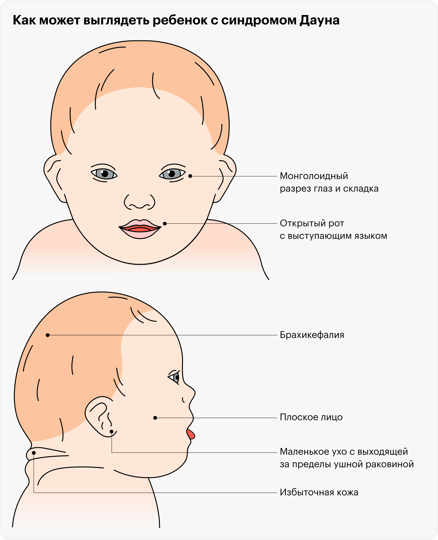 Люди с синдромом Дауна похожи между собой, потому что имеют сходные черты внешности: косой разрез глаз, маленький рот с выступающим языком, маленькие уши, уплощенный затылок и лицо, складки на задней поверхности шеи. Эти черты могут быть выражены в разной степени или отсутствовать совсем