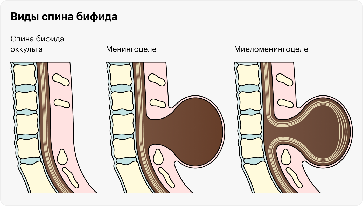 Ученые выделяют три вида расщепления позвоночника: спина бифида оккульта — когда в позвоночнике есть небольшой зазор, менингоцеле — когда из расщелины выступает спинномозговая оболочка с жидкостью, но спинного мозга в ней нет, и миеломенингоцеле — когда из расщелины выступает часть спинного мозга