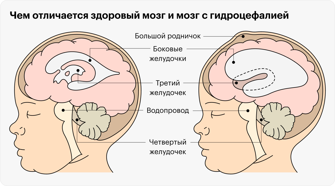В норме спинномозговая жидкость оттекает из боковых желудочков в третий, а затем через водопровод — в четвертый. Оттуда жидкость попадает пространство между черепом и мозгом и создает амортизирующую прослойку. Из этого пространства жидкость дальше оттекает через отверстие в затылке в центральный канал спинного мозга. Если на любом из этих участков возникает препятствие оттоку, жидкость накапливается и сдавливает мозг. У грудных детей при этом кроме увеличения головы можно увидеть, как выпирает большой родничок