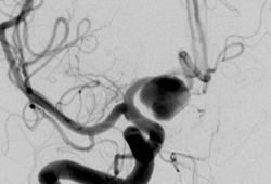Так выглядит расширение артерии головного мозга на ангиографии сосудов. Источник: bmg.com
