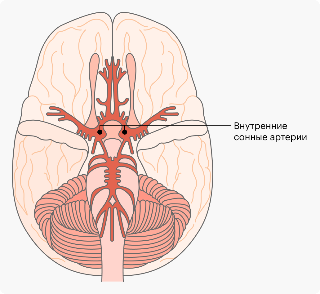 У меня была аневризма левой внутренней сонной артерии