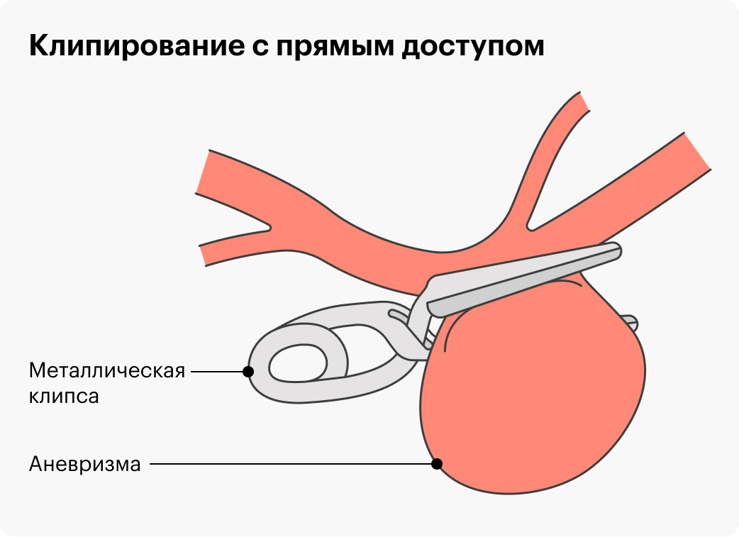 Во время открытой операции аневризму пережимают маленькой металлической клипсой