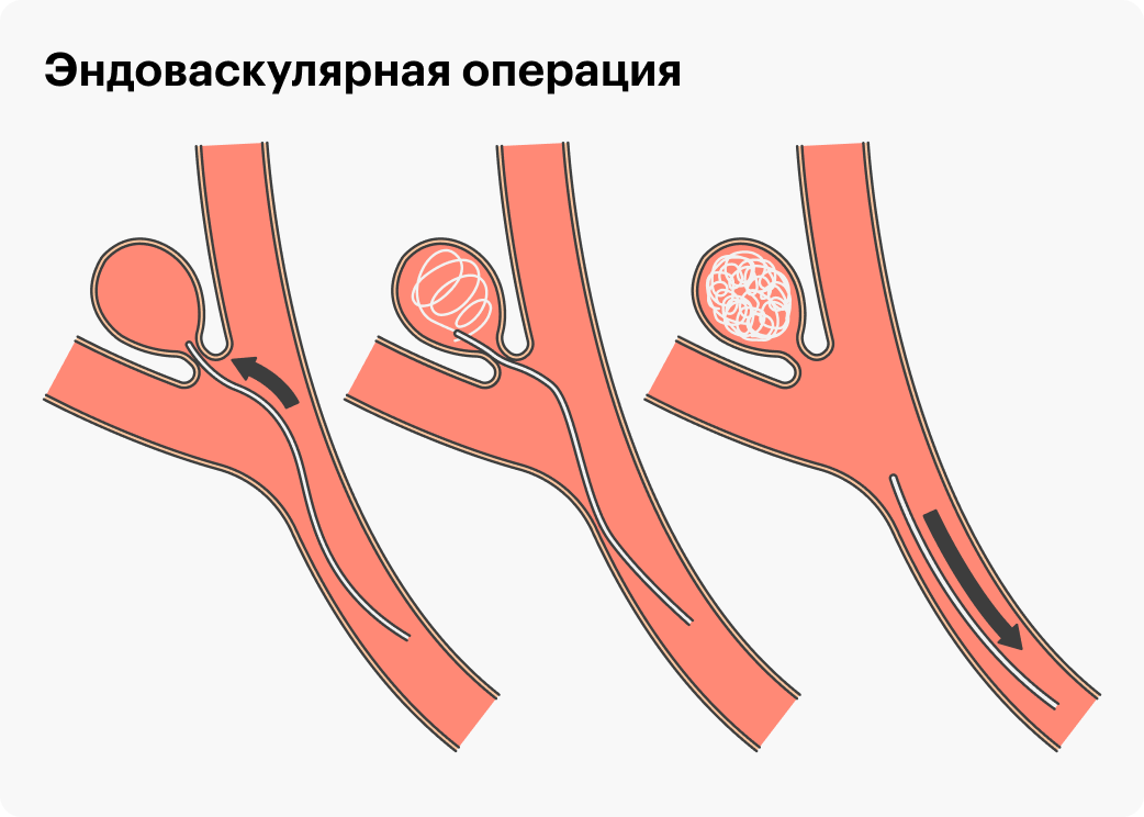 В случае эндоваскулярной операции в аневризму помещают тоненькую нить, которая перекрывает кровоток