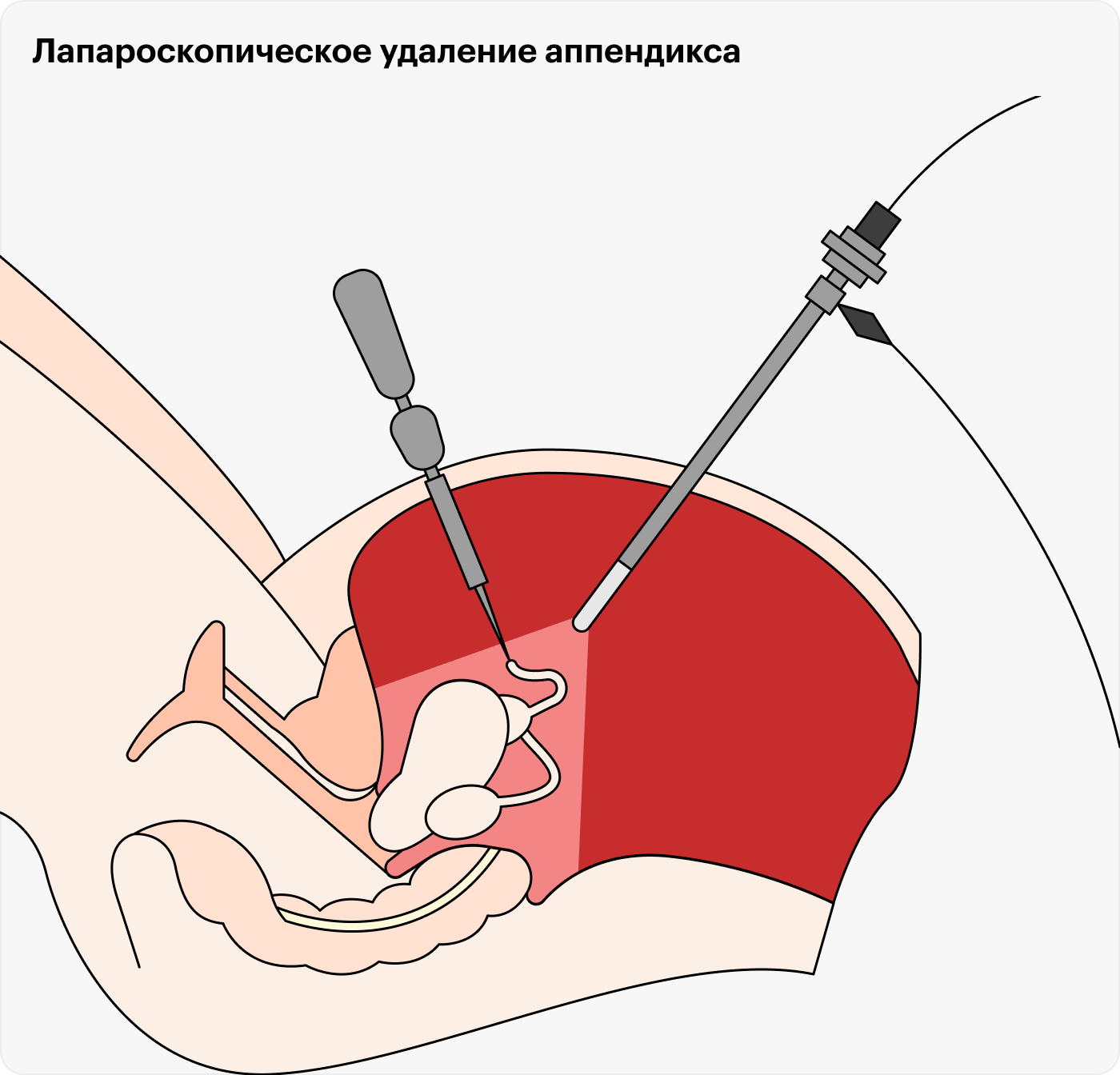 Лапароскопическое удаление аппендикса меньше травмирует ткани