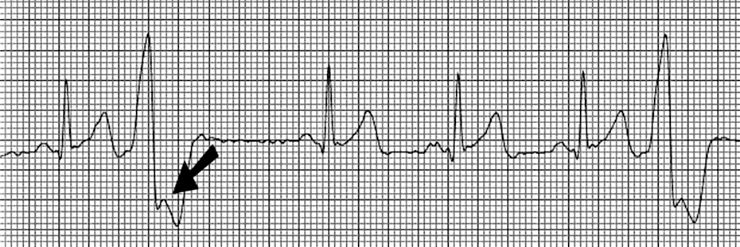 Так выглядят экстрасистолы на ЭКГ. После внеочередного сокращения наступает более длинная пауза, а потом сердцебиение возобновляется с нормальным ритмом до следующего эпизода. Источник: equimedcorp.com