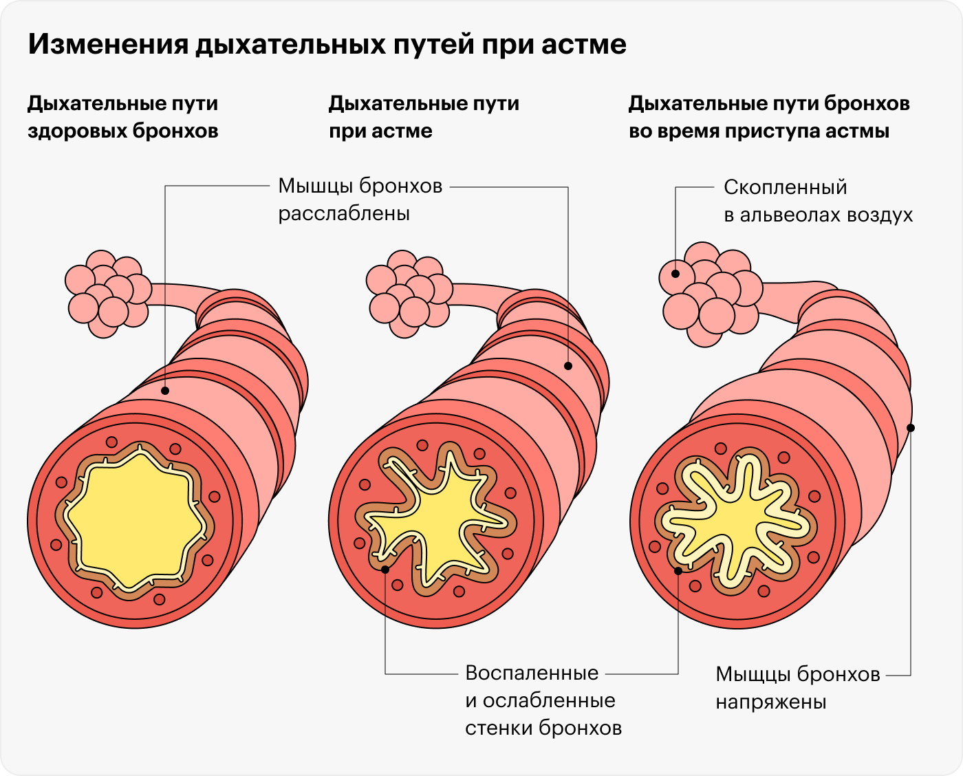 Поскольку во время приступа астмы дыхательные пути сужаются, человеку приходится прилагать немалые усилия, чтобы дышать