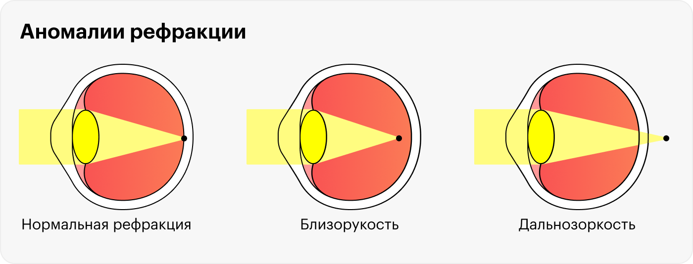 При близорукости изображение фокусируется перед сетчаткой, а при дальнозоркости — за ней