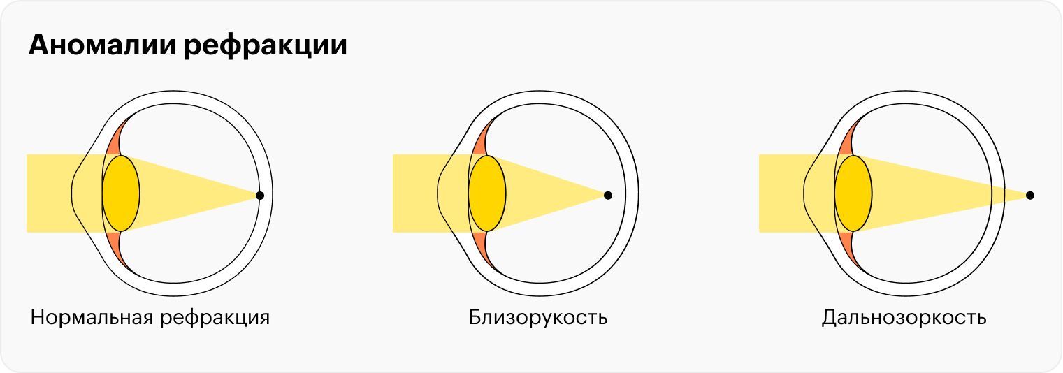 А вот так световая информация попадает в глаз при аномалиях рефракции. При близорукости из⁠-⁠за этого сложно сфокусироваться на отдаленных предметах, а при дальнозоркости — на близких