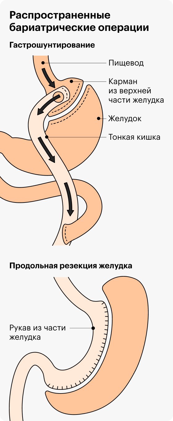 Баллон занимает место в желудке и помогает меньше есть