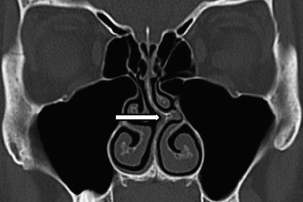 На компьютерной томографии видно, что перегородка носа искривлена и перекрыла один носовой проход, — это показано стрелкой. Источник: справочник MSD