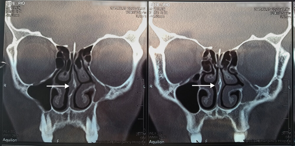 На компьютерной томографии отчетливо видно искривление носовой перегородки