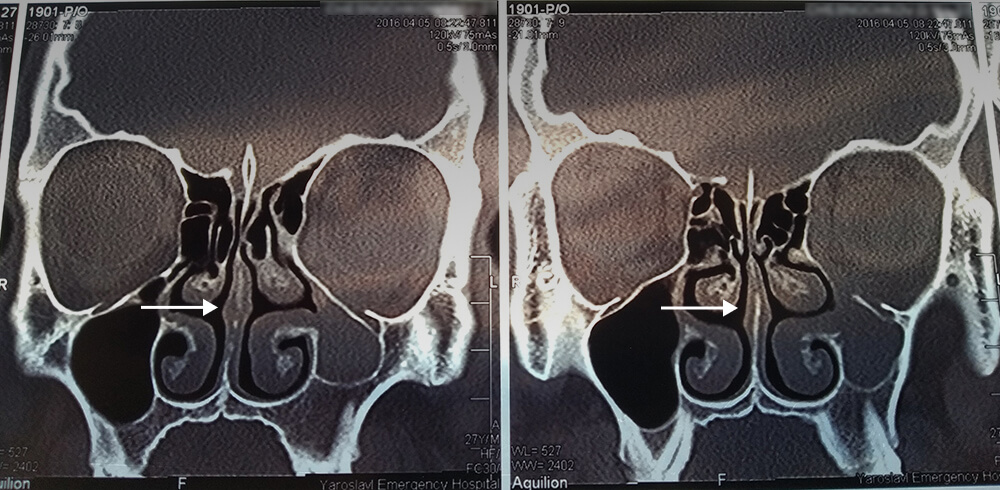 Компьютерная томография через шесть с половиной месяцев после операции. Носовая перегородка практически прямая, носовые проходы одинаковой ширины. Но внимательные читатели и эксперты Т⁠⁠—⁠⁠Ж заметили, что на снимках видны признаки синдрома молчащего синуса — достаточно редкого состояния, которое могло стать причиной двоения в глазах. Автор статьи обратится к врачу и проконсультируется по поводу дальнейшего хирургического лечения