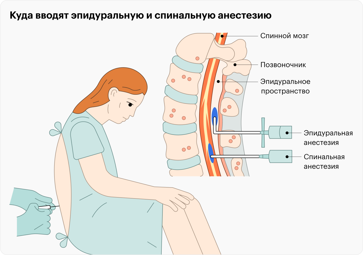 Для спинальной анестезии обезболивающее вводят чуть глубже, чем для эпидуральной