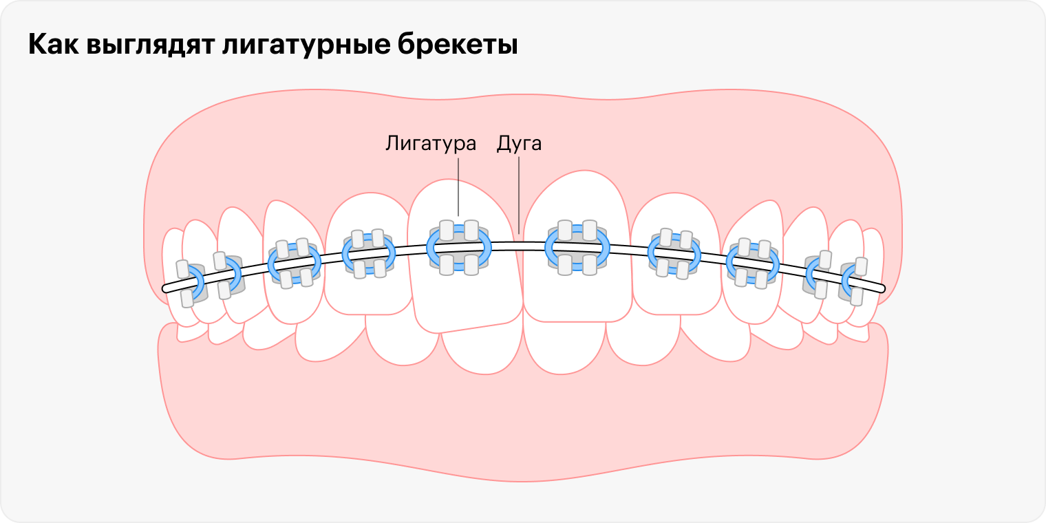 Лигатурные металлические брекеты могут травмировать слизистую рта