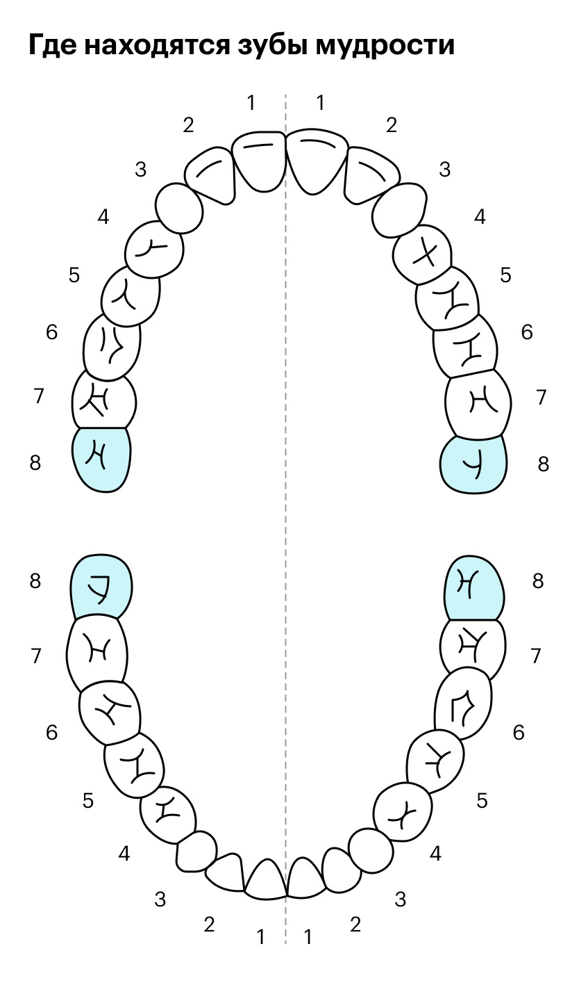 Зубы мудрости — это третьи моляры, то есть самые последние жевательные зубы. В стоматологии есть несколько систем нумерации зубов. По одной из них отсчет начинают со средней линии, тогда третьи моляры будут на восьмой позиции, поэтому их часто называют восьмерками