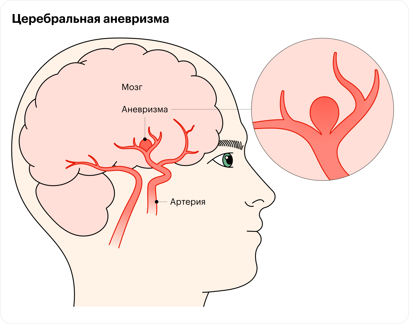 В большинстве случаев аневризмы выглядят как наполненные кровью мешочки на ножках