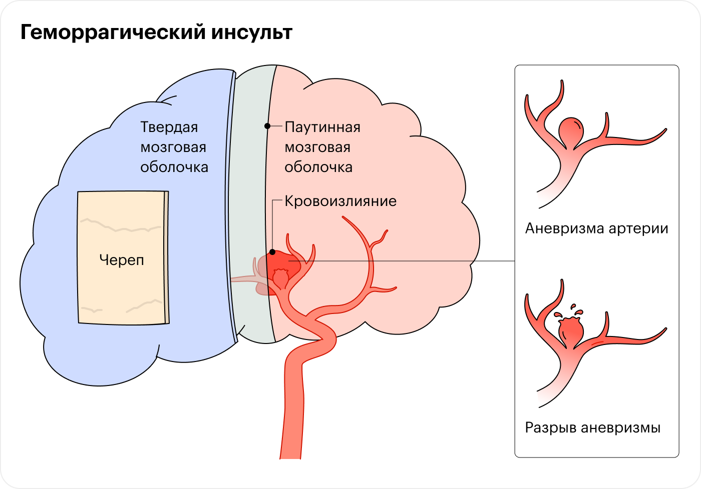 Главный симптом разрыва аневризмы — очень сильная головная боль. Еще могут быть тошнота, рвота, скованность мышц шеи, нарушения речи, зрения, слабость в руки или ноге. Источник: American Stroke Association