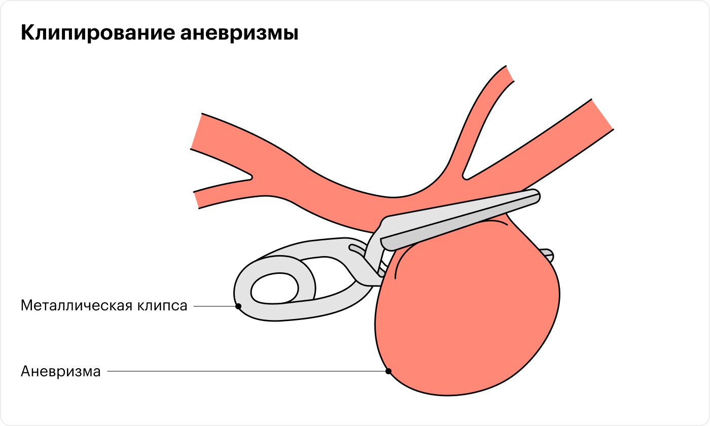 Хирург делает отверстие в черепе и через него подбирается к аневризме