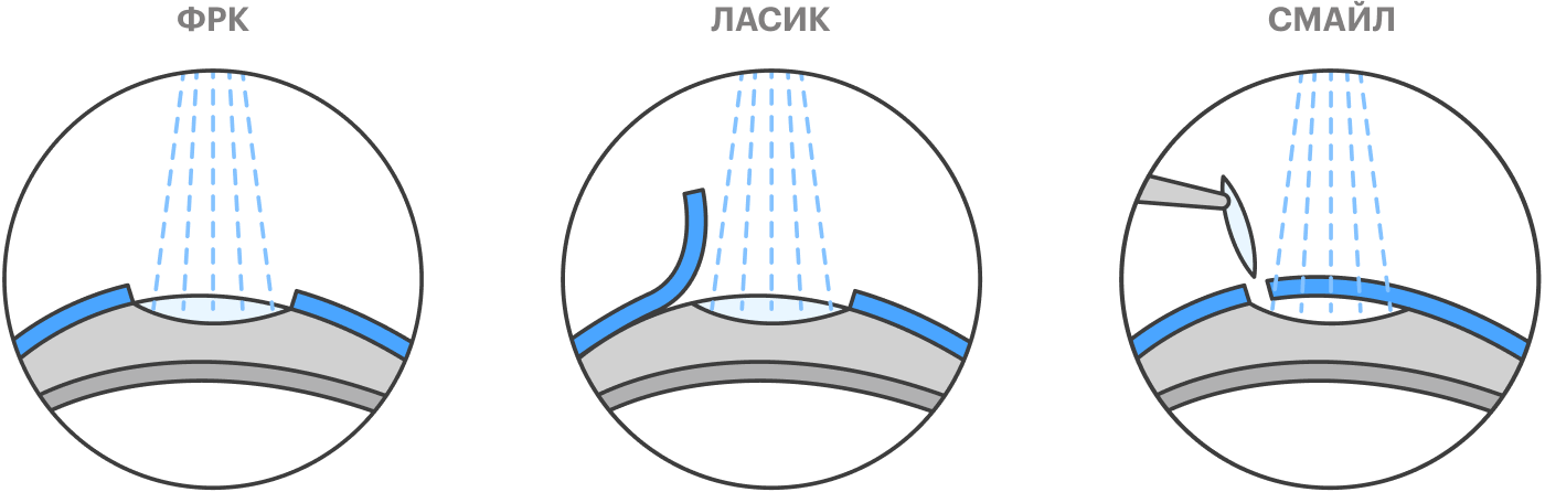 ФРК — когда удаляют часть поверхностных тканей роговицы глаза и потом обрабатывают ее лазером. «Ласик» — когда роговицу обрабатывают лазером под лоскутом из поверхностных тканей, а затем возвращают лоскут на место. «Смайл» — когда фрагмент средней части роговицы удаляют через небольшой разрез