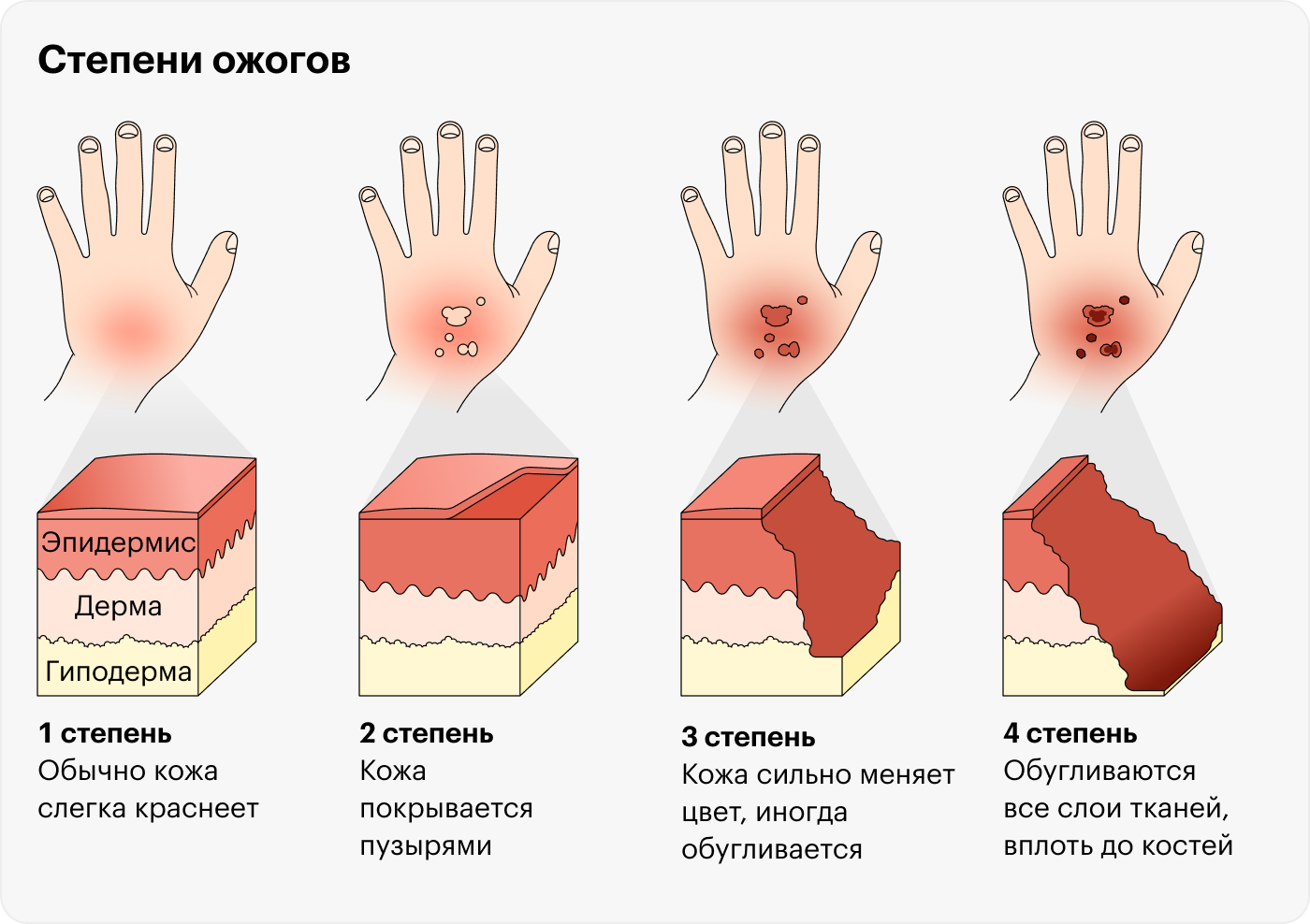 Так выглядят ожоги разной степени тяжести. Если на первой стадии поражается только верхний слой кожи, эпидермис, то на четвертой обугливаются все слои тканей вплоть до костей