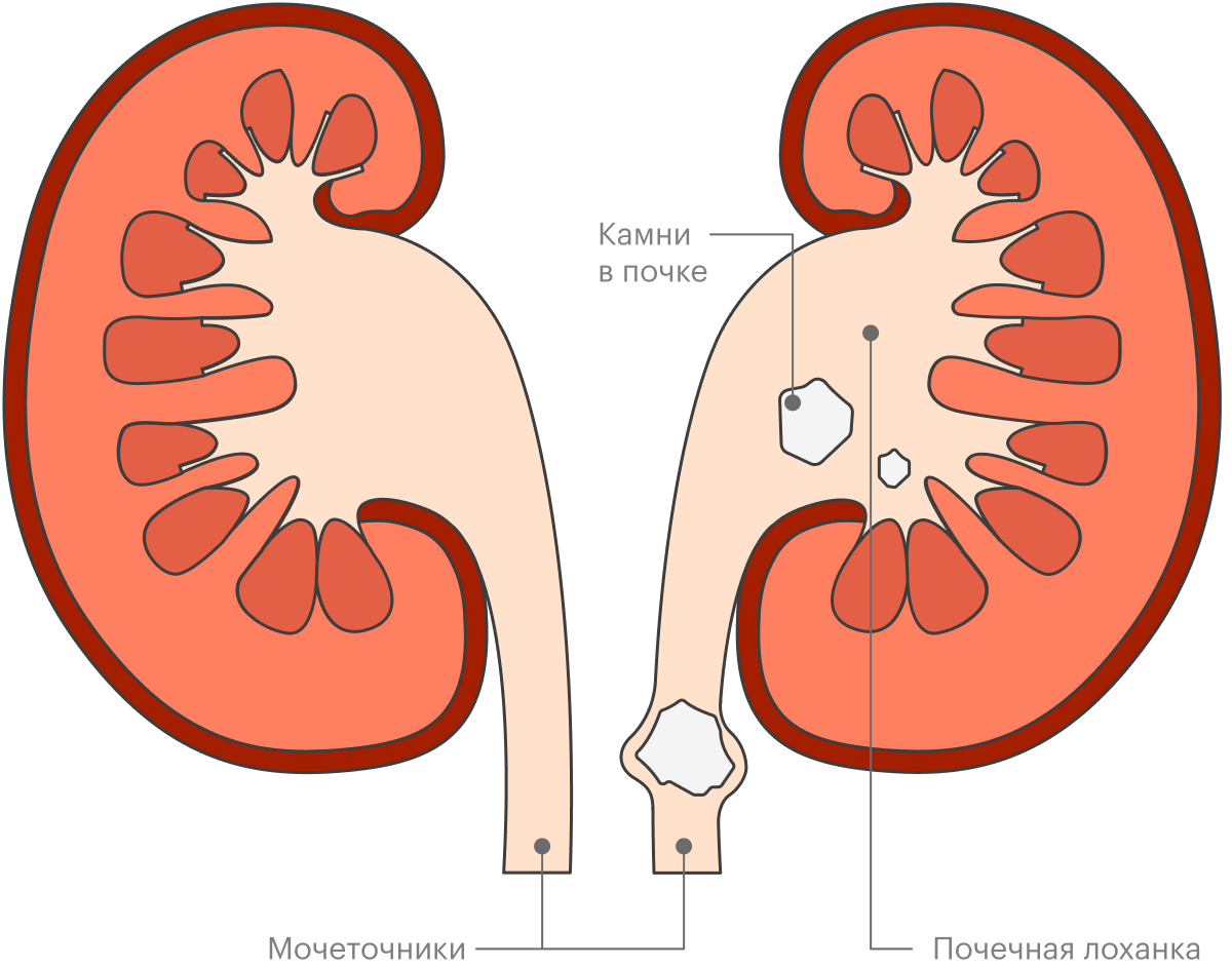 Камни образуются в почке, но покидают их через мочеточник