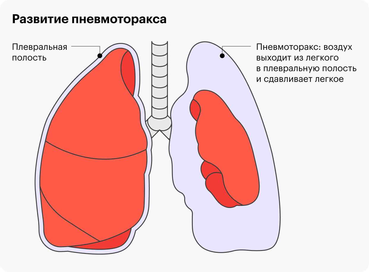 Пневмоторакс лечат в том числе удалением воздуха из плевральной полости, что помогает вернуть легкое в нормальное положение