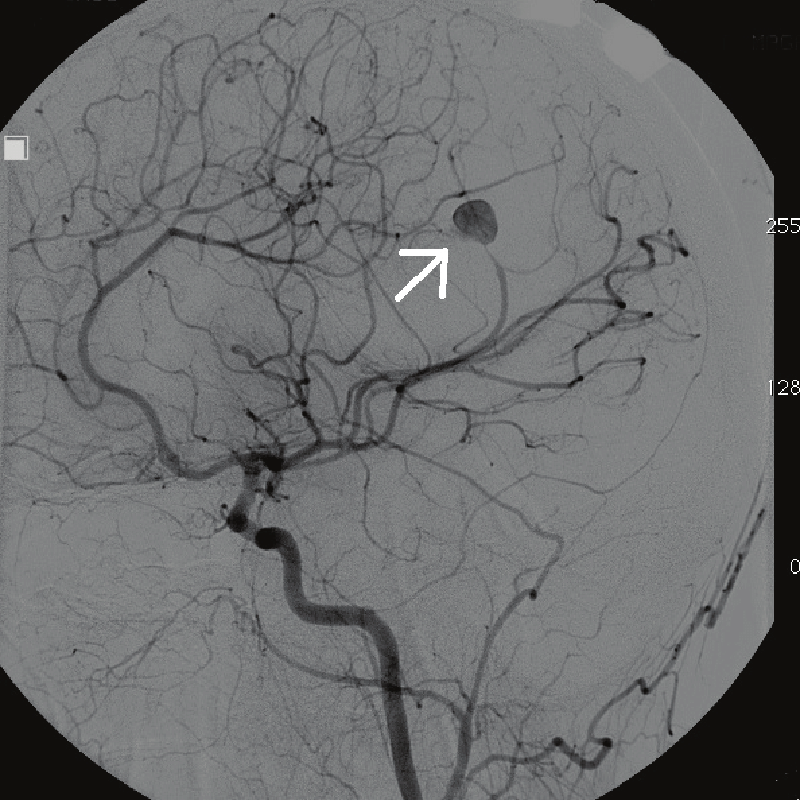 Аневризма сосудов головного мозга на ангиографии. Источник: Research gate