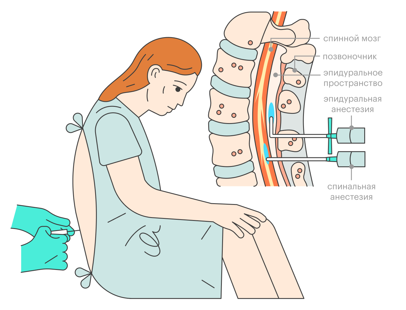 При эпидуральной анестезии врач оставляет на месте укола катетер, через который можно добавить анестетик. Спинальная анестезия — разовая процедура, ее действие продлить нельзя. Иногда врачи комбинируют оба варианта