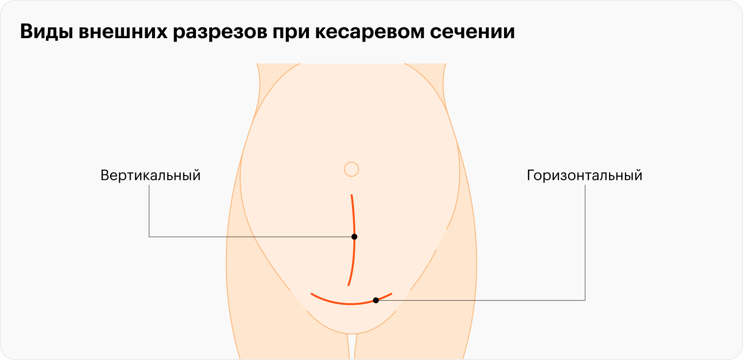 Горизонтальный разрез при кесаревом сечении лучше как минимум с косметической точки зрения: его можно спрятать под нижним бельем