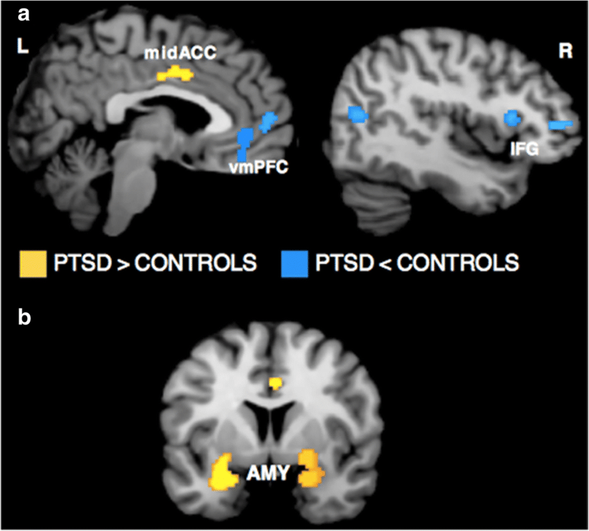 На снимках — мозг людей с посттравматическим стрессовым расстройством и без него. У людей с посттравматическим расстройством наблюдается повышенная активность дорсолатеральной префронтальной и ретросплениальной коры головного мозга, а также миндалевидного тела, и пониженная активность — вентромедиальной префронтальной коры. Источник: ResearchGate