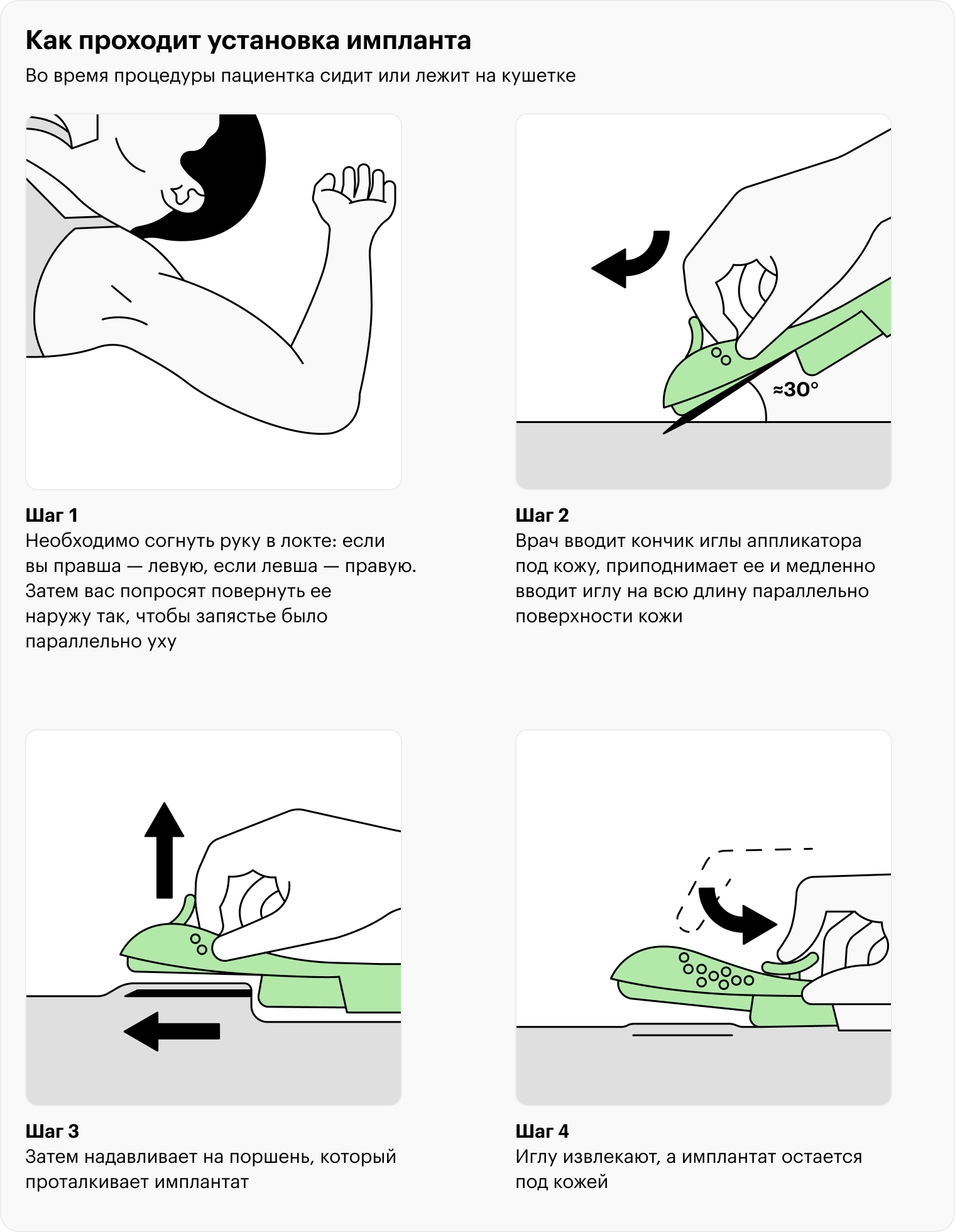 Во время процедуры пациентка сидит или лежит на кушетке. Надо согнуть руку в локте: если вы правша — левую, если левша — правую. Затем вас попросят повернуть ее наружу так, чтобы запястье было параллельно уху. После обезболивания врач вводит кончик иглы аппликатора под кожу, приподнимает ее и медленно вводит иглу на всю длину параллельно поверхности кожи. Затем надавливает на поршень, который проталкивает имплантат. Иглу извлекают, а имплантат остается под кожей. Источники: Drugs.com, «Только девушке»