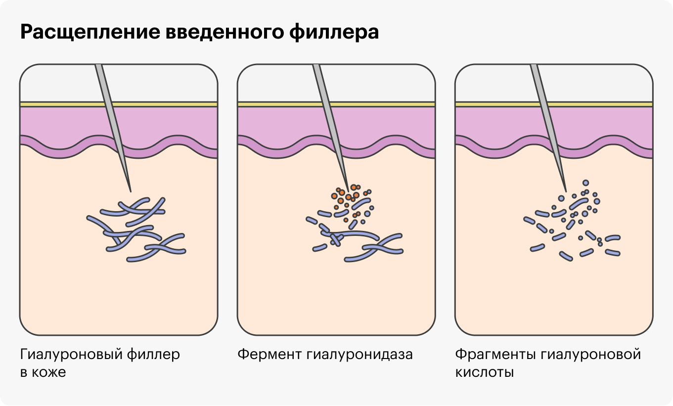 Филлеры расщепляют с помощью специальных ферментных препаратов