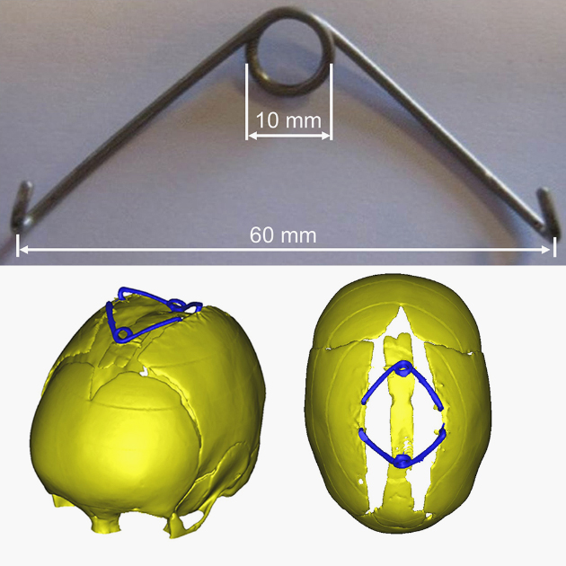 Пружины для внутренней дистракции. Источник фотографии: Journal of Neurosurgery: Pediatrics