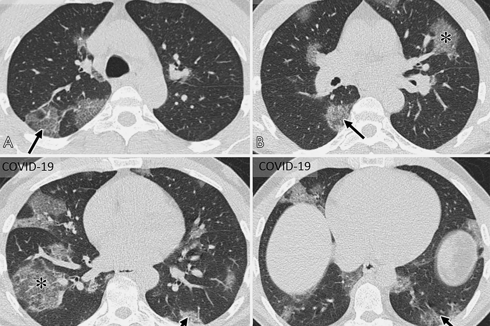 КТ-изображение нескольких «ломтиков» грудной клетки. Источник: pubs.rsna.org