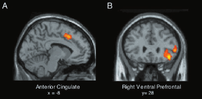Мозг человека, которого отвергли. На изображении слева — повышенная активность передней поясной коры. Справа — чрезвычайно активная правая вентральная префронтальная кора. Источник: researchgate.net