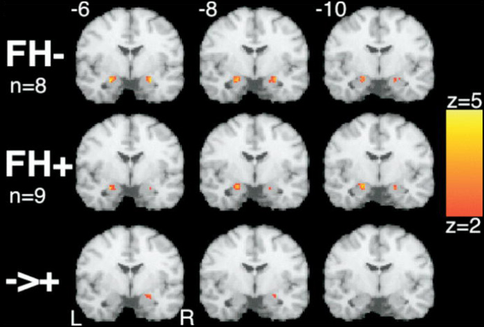 Сканы фМРТ с активацией миндалины при виде пугающего выражения лица у двух групп людей. Первая группа, сверху — люди без истории алкоголизма в семье. Их мозг реагирует правильно: миндалины идентифицируют угрозу и активны. Вторая группа — взрослые дети алкоголиков. Их миндалины почти не реагируют на потенциальную опасность. Источник: pubmed.ncbi.nlm.nih.gov
