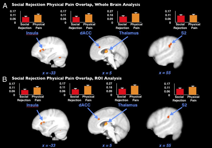 На изображении — области мозга, которые активируются и при отвержении, и при физической боли. Графики иллюстрируют, насколько интенсивна активация той или иной области в каждом случае. Источник: pnas.org