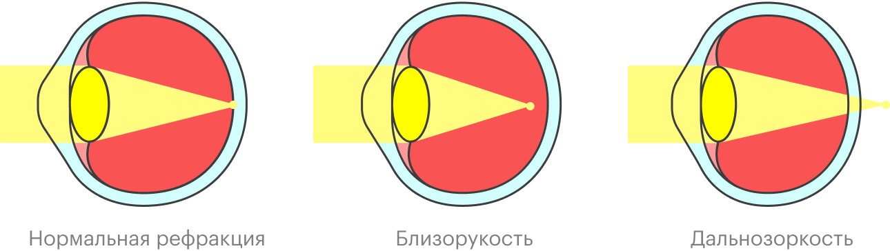 При близорукости изображение фокусируется перед сетчаткой, а при дальнозоркости — за ней