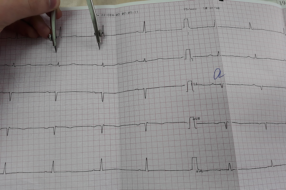 ЭКГ печатают на миллиметровке, от которой иногда рябит в глазах