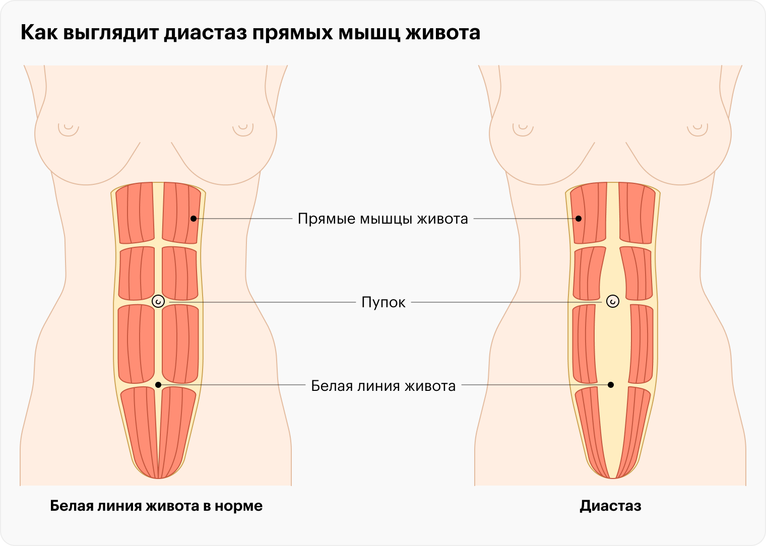 При диастазе происходит аномальное расхождение прямых мышц живота. Оно может быть над пупком, под ним, или сверху и снизу пупка одновременно