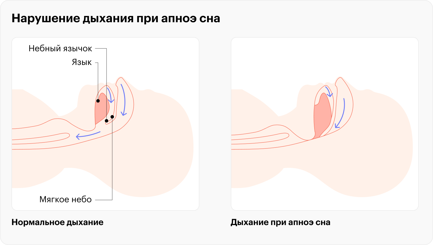 Связь между ожирением и апноэ сна двусторонняя. Лишний вес вызывает апноэ сна, так как у полных людей воздух хуже проходит через дыхательные пути. Кроме того, оно может развиться из⁠-⁠за заболеваний лор⁠-⁠органов. При этом апноэ сна, в свою очередь, усугубляет ожирение, если оно уже есть, и может способствовать набору лишнего веса, когда его нет