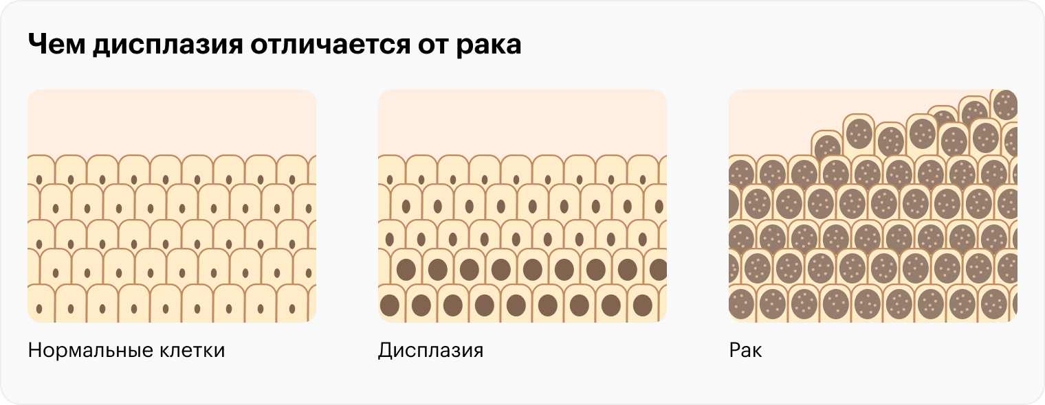 При дисплазии клетки изменены, но они еще не стали раковыми и не распространяются за пределы органа. Лечение зависит от степени дисплазии: в легких случаях она может пройти сама, при значительном изменении клеток нужно удалять патологический очаг