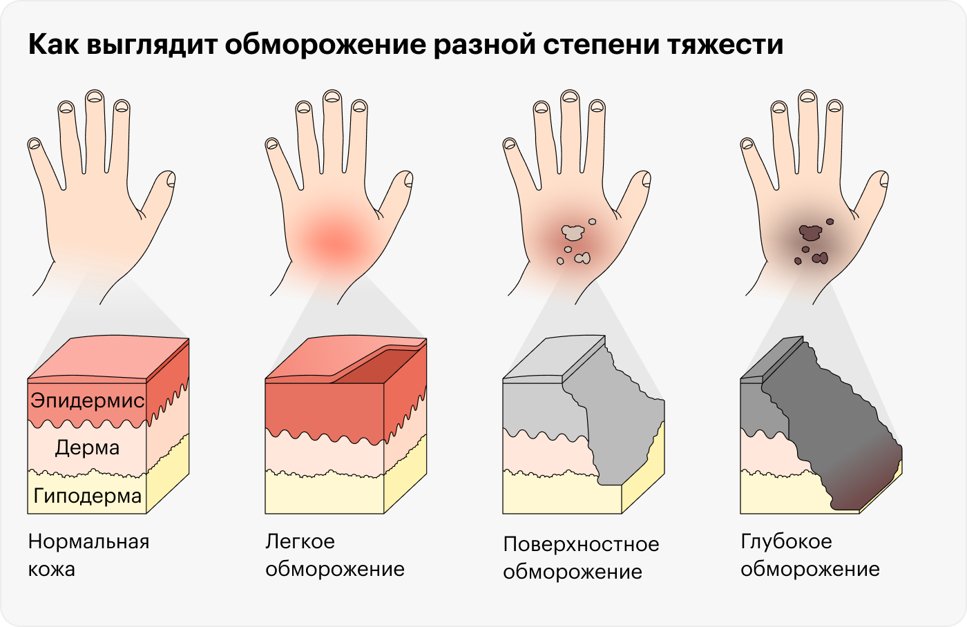 Если на первой стадии обморожения поражается только поверхностный слой кожи — эпидермис, то глубокое обморожение поражает все слои тканей