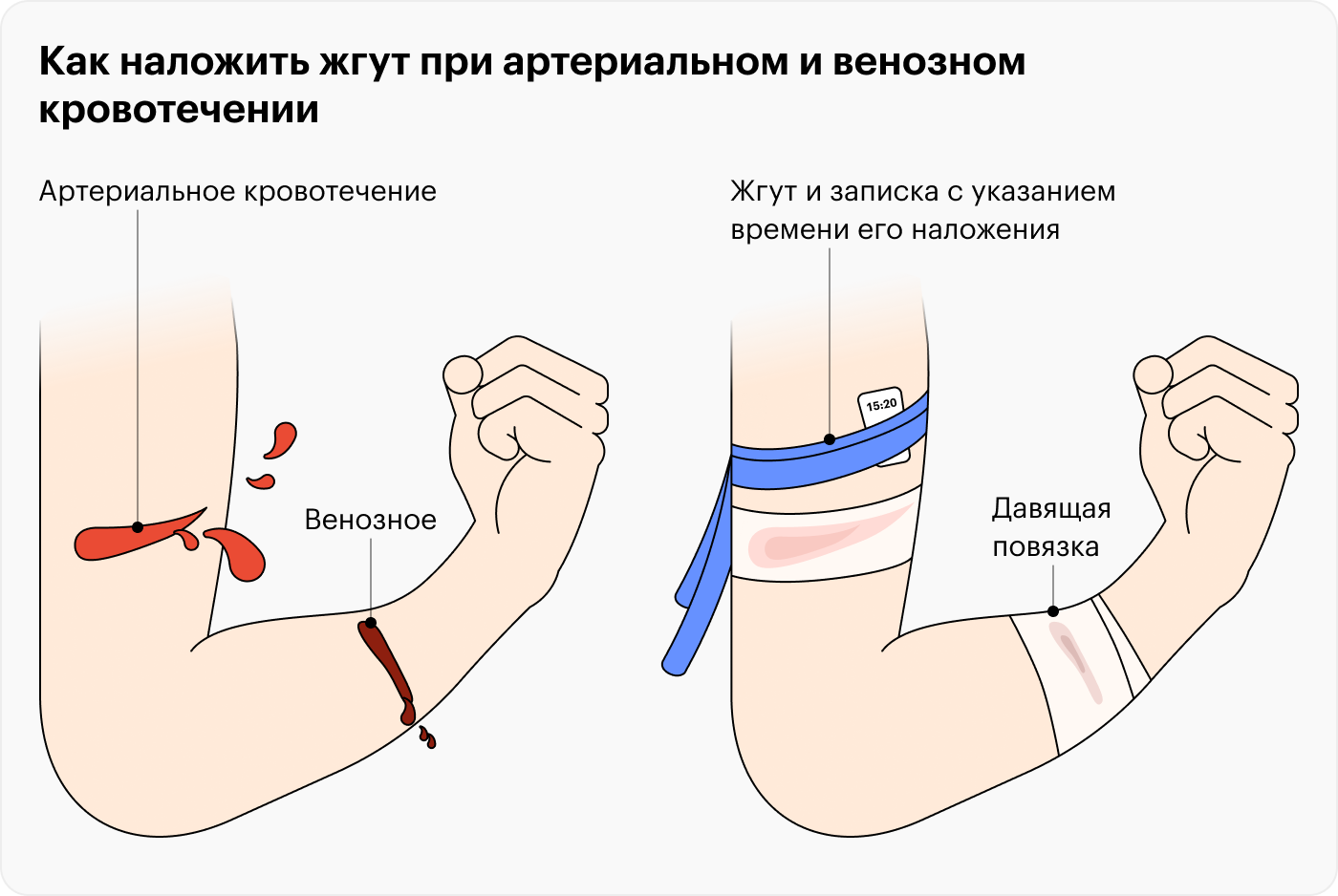 Жгут помогает остановить кровотечение из крупных вен и артерий, если давящие повязки из бинтов не помогают. Это навык, которому нужно учиться заранее — на курсах оказания первой помощи. Неправильное наложение жгута может обернуться ампутацией