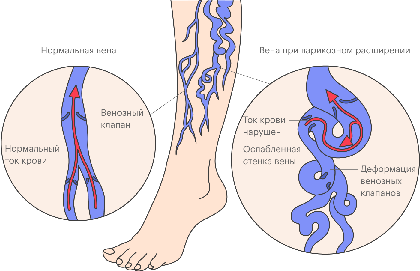 По одной из теорий варикозное расширение вен возникает из⁠-⁠за врожденной слабости венозной стенки. Под давлением крови вена постепенно растягивается, со временем деформируются венозные клапаны, поэтому появляются симптомы венозной недостаточности