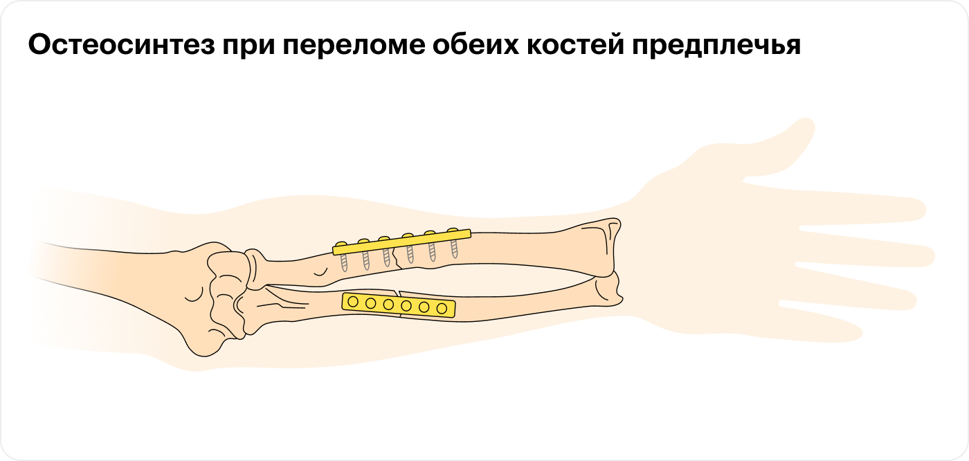 Остеосинтез при переломе обеих костей предплечья